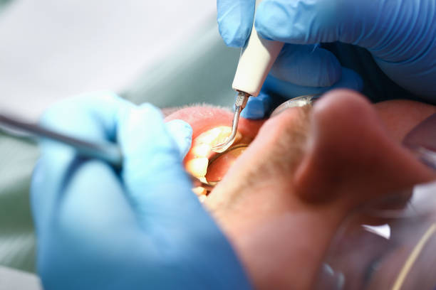 Best Knocked-Out Tooth (Avulsed Tooth) Treatment in Oceanside, CA