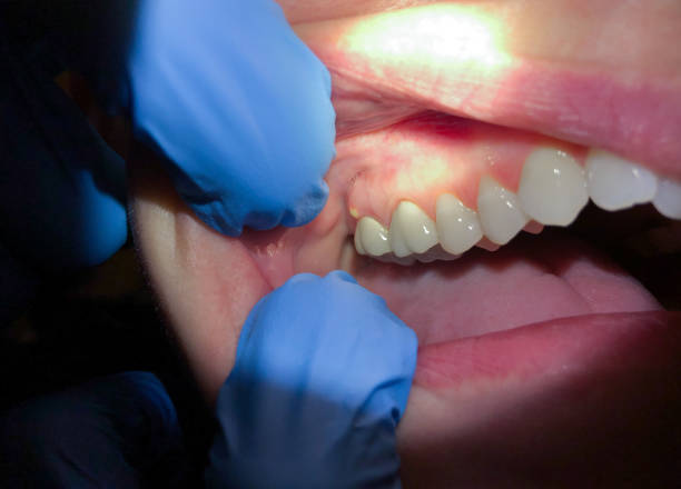 Best Emergency Wisdom Tooth Extraction in Oceanside, CA